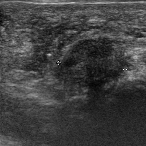 Fibrosi perineurale Civinini-Morton