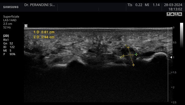 Neuroma di Morton