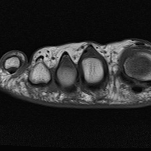 Neuroma di Morton